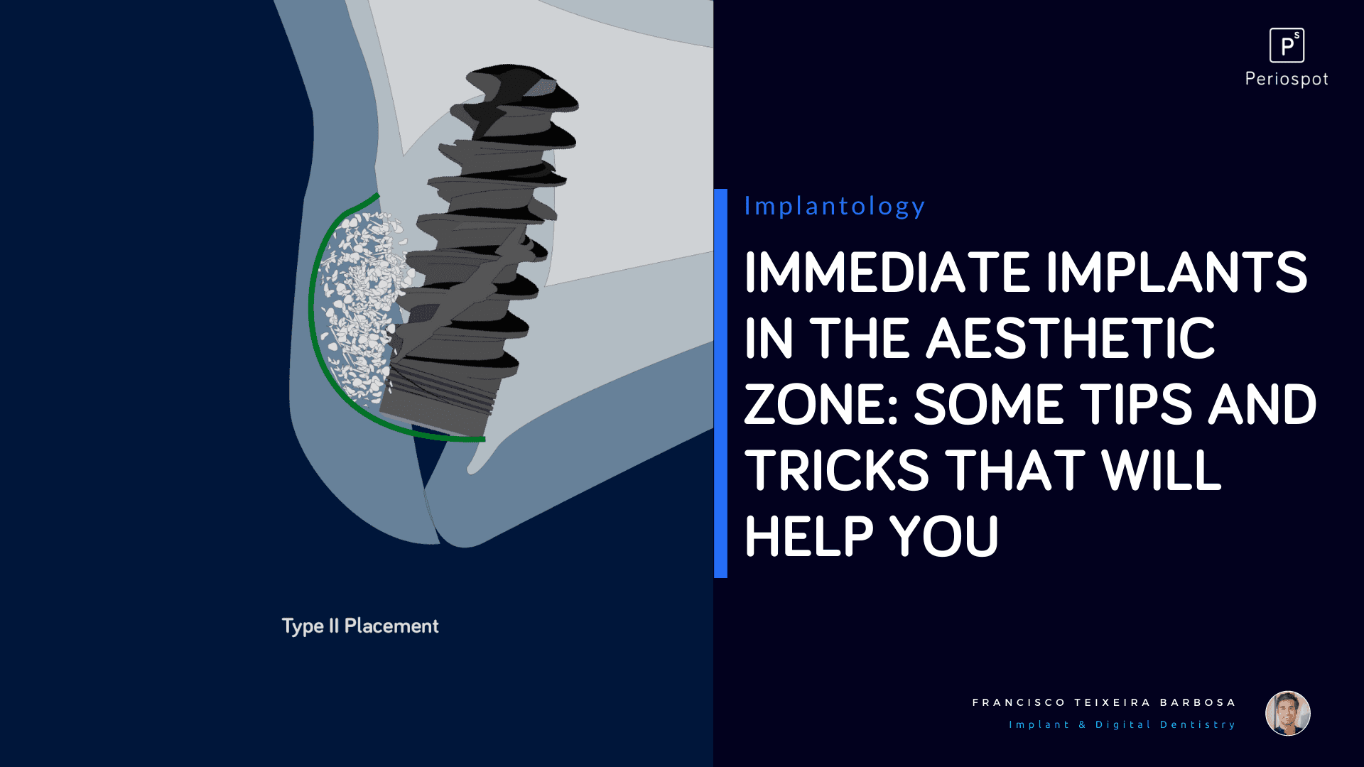 Immediate Implants in the Aesthetic zone: Some tips and tricks that will help you