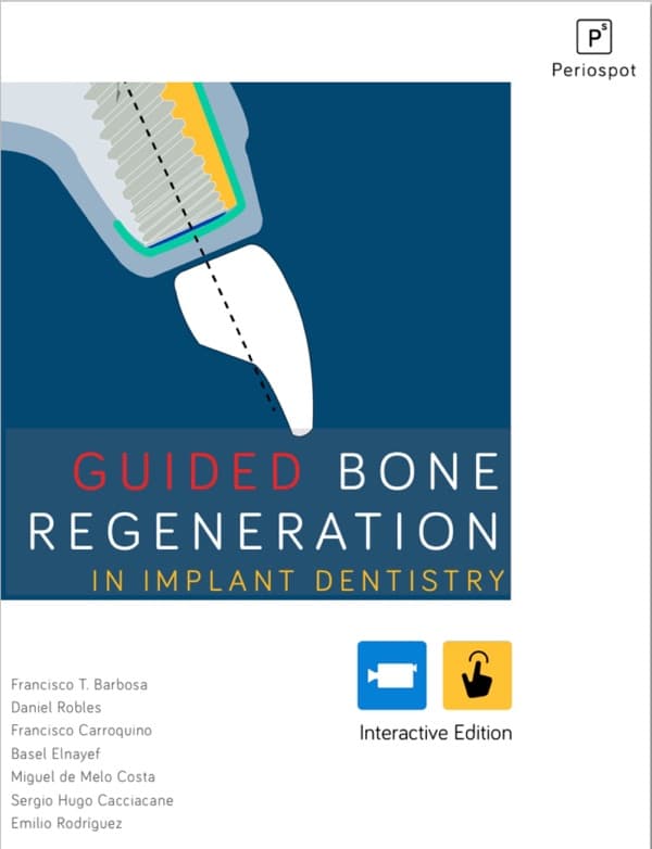 Guided Bone Regeneration in Implant Dentistry