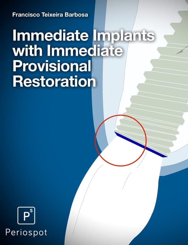 Oral Implantology: Immediate Implant Immediately Restored