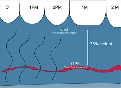 Connective tissue graft techniques. Great palatine artery