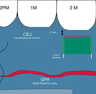 connective tissue graft from the posterior palate