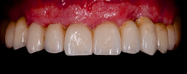 Twin flash dental photography setup