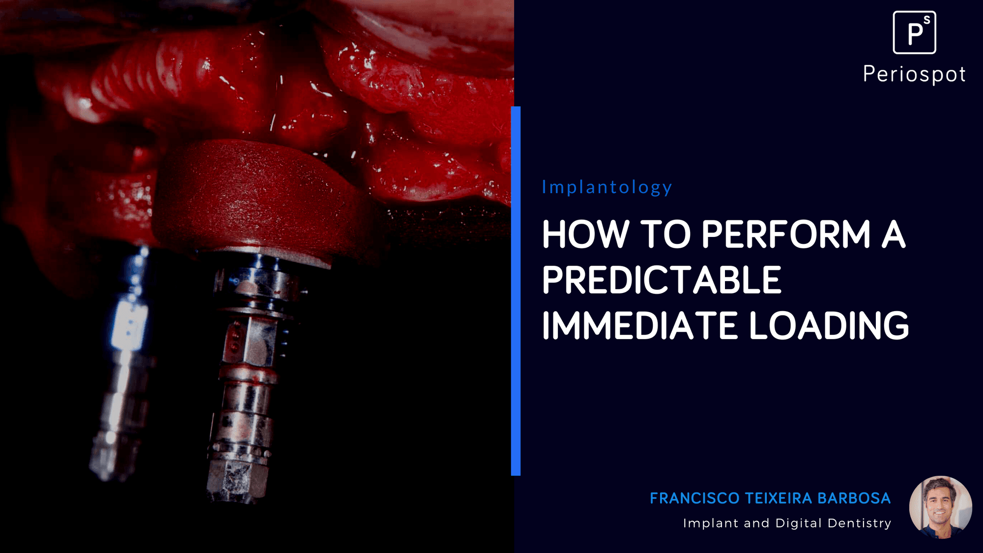 How to perform a predictable immediate loading