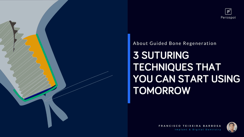 3 Suturing Techniques For Guided Bone Regeneration That You Can Start Using Tomorrow