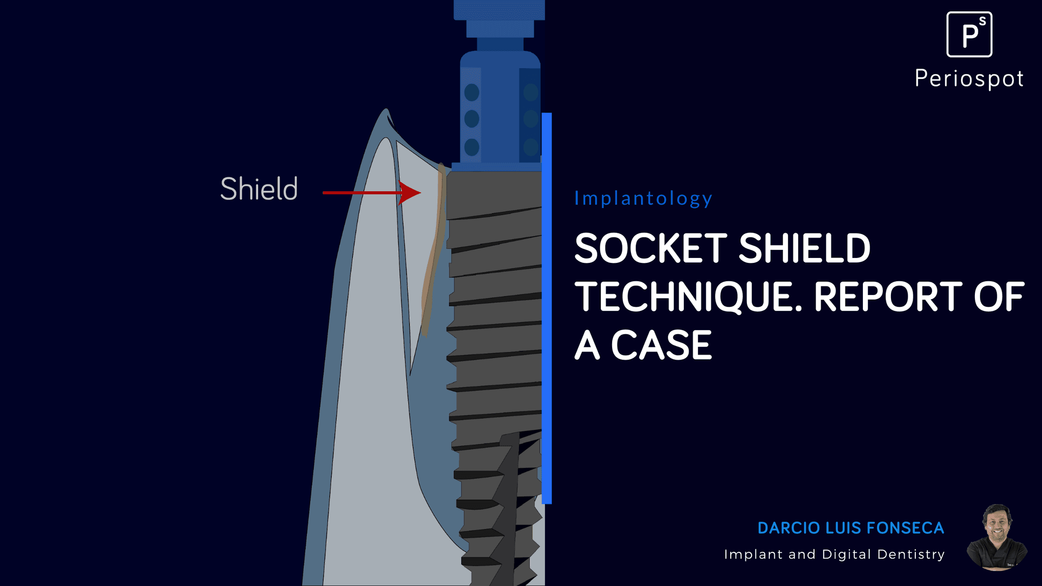 Socket Shield Technique. Report of a case.