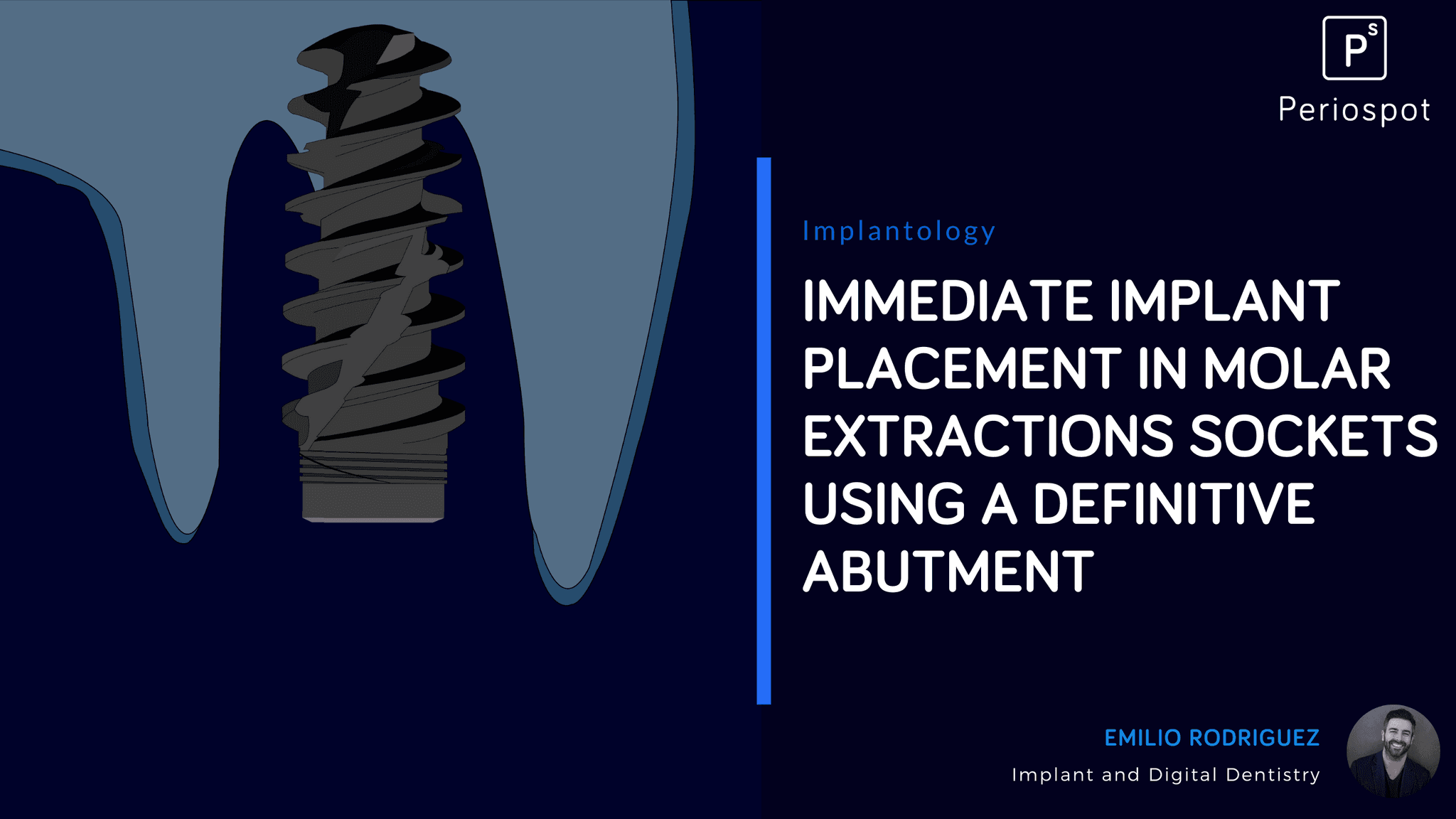 Immediate implant placement in molar extractions sockets using a definitive abutment.