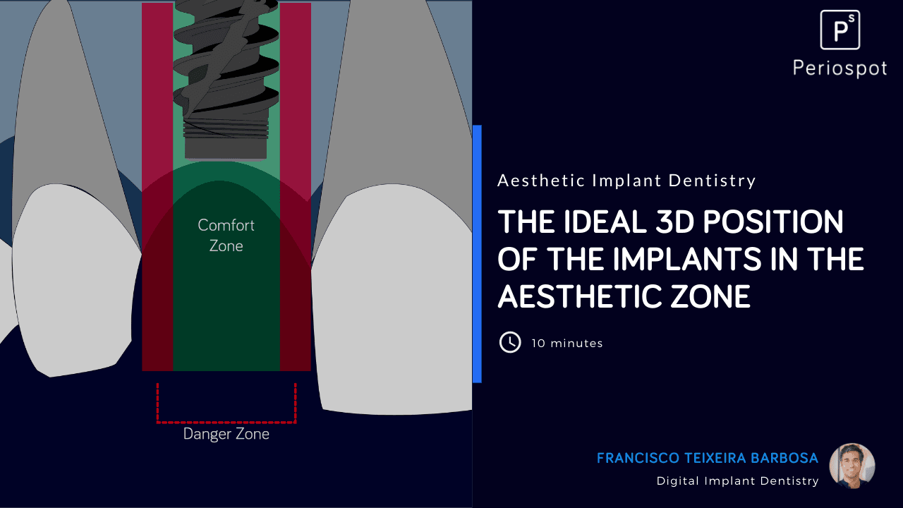 The Ideal Implant Position in the Aesthetic Zone.