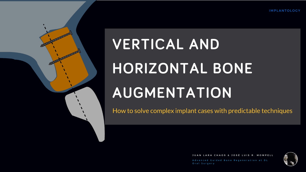 Vertical and Horizontal Bone Augmentation- How to solve complex implant cases with predictable techniques