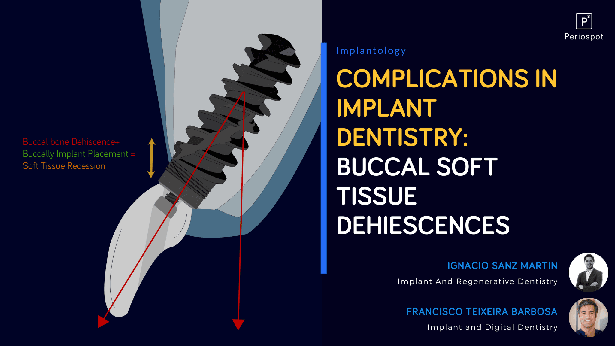 Complications in Dental Implant Dentistry: Buccal Soft Tissue Dehiscences