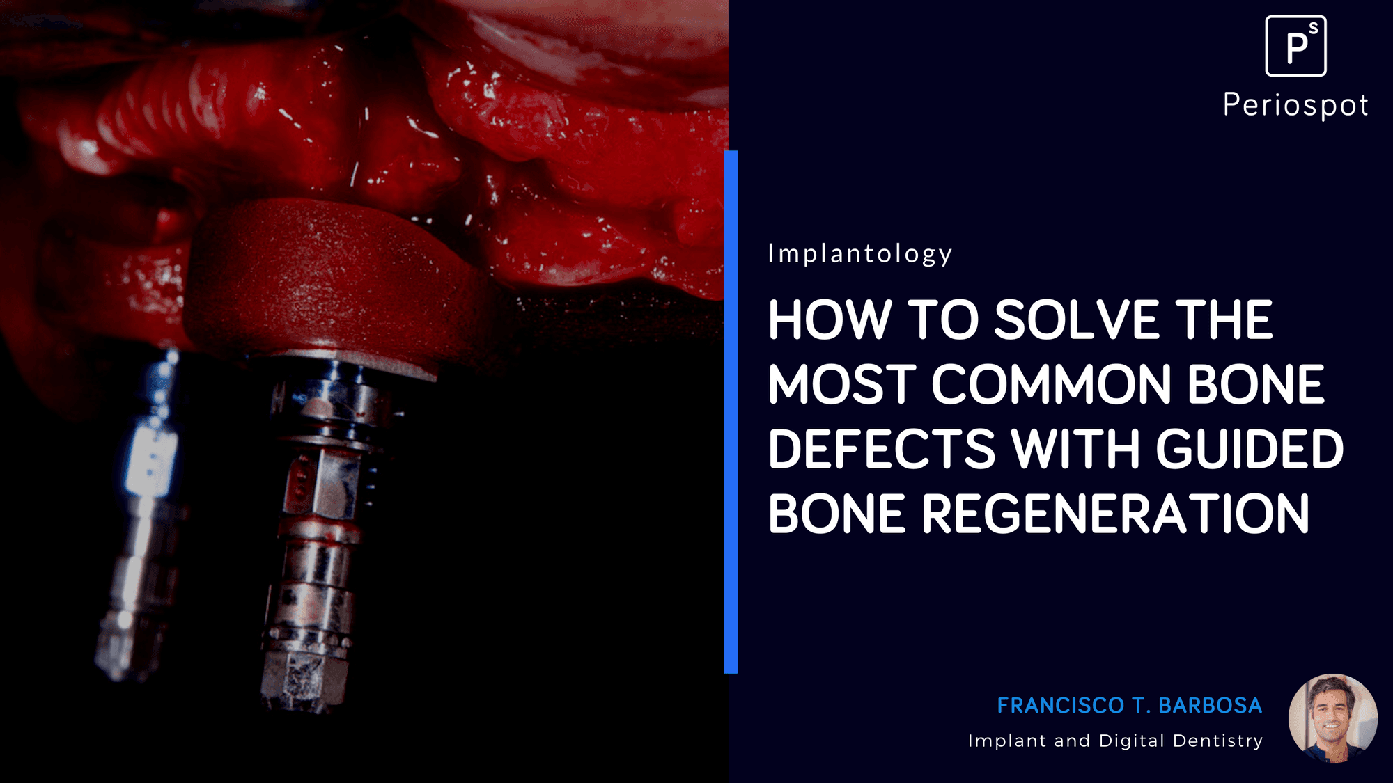 How to Solve the Most Common Bone Defects With Guided Bone Regeneration