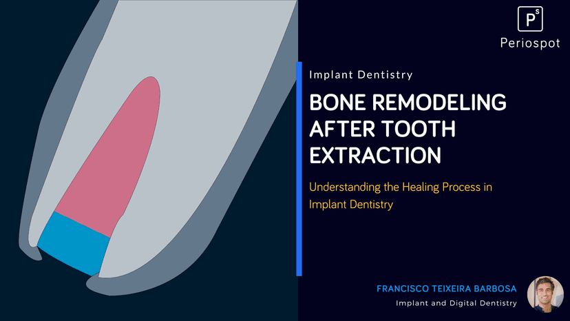 Bone Remodeling After Tooth Extraction: Understanding the Healing Process in Implant Dentistry