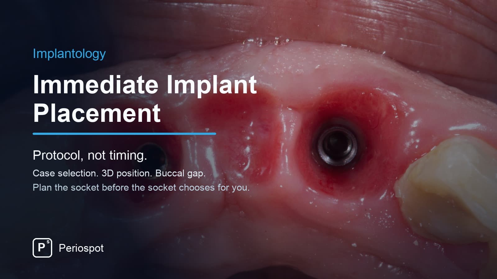 Immediate Implant Placement: A Protocol for Case Selection and Predictable Results