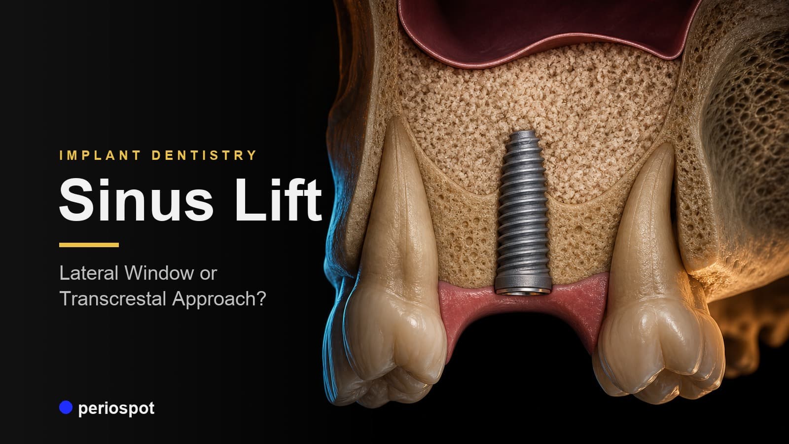 Sinus Lift in Implant Dentistry: Lateral Window or Transcrestal Approach?
