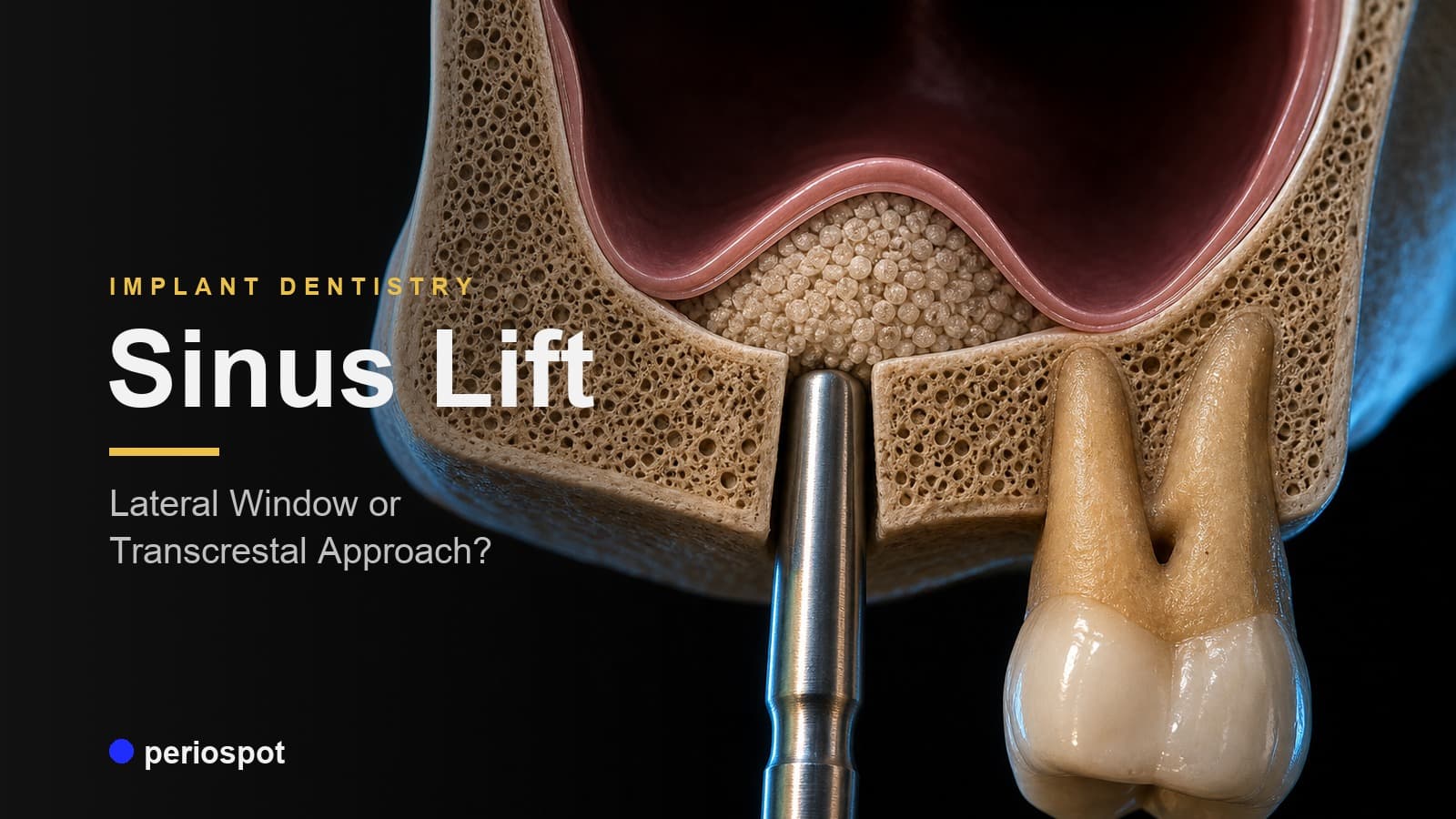 Sinus Lift in Implant Dentistry: Lateral Window or Transcrestal Approach?
