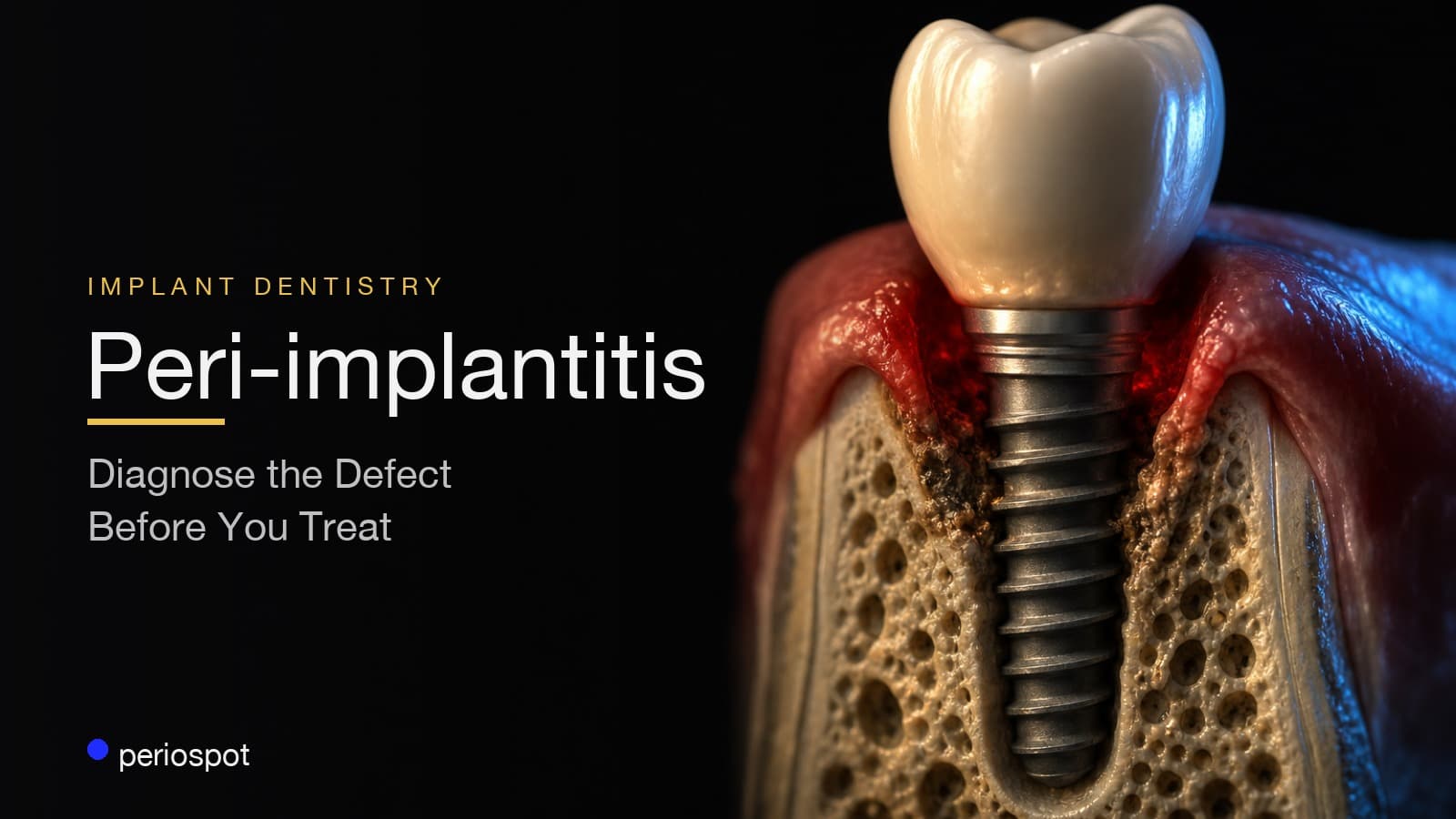 Peri-implantitis Treatment: Diagnose the Defect Before You Treat the Implant