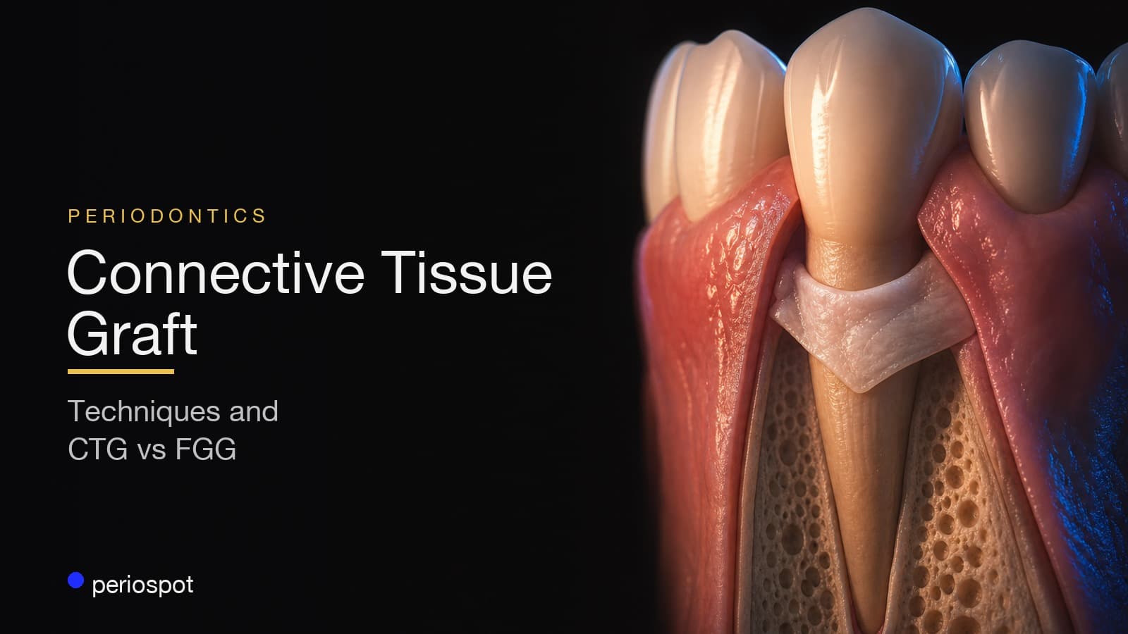 The Connective Tissue Graft: Harvesting Techniques, Indications, and CTG vs FGG
