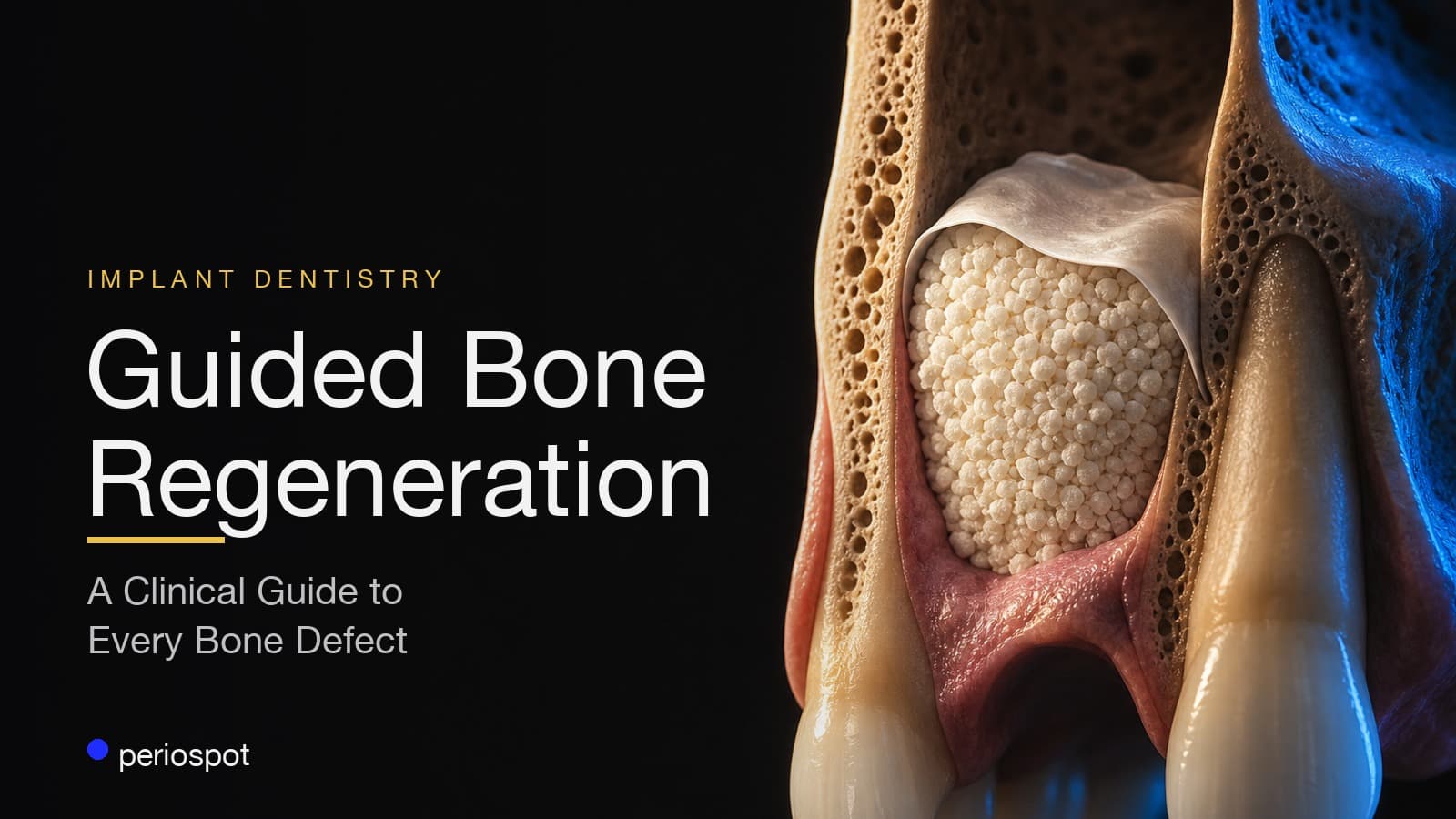 Guided Bone Regeneration: A Clinical Guide to Every Bone Defect