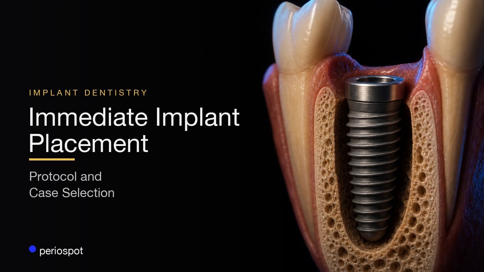 Immediate Implant Placement: A Protocol for Case Selection and Predictable Results