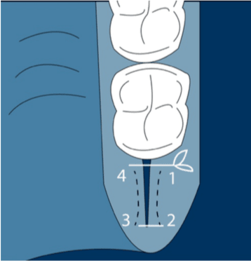 Técnicas de injerto de tejido conectivo de la tuberosidad. Suturas.