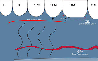 Connective tissue graft techniques. Great palatine artery