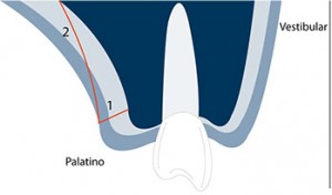 Connective tissue graft techniques step 2