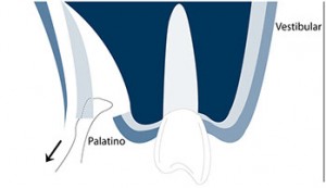 Connective tissue graft techniques step 3