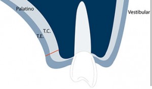 Connective tissue graft techniques step 1