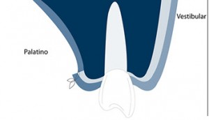 Connective tissue graft techniques step suturing