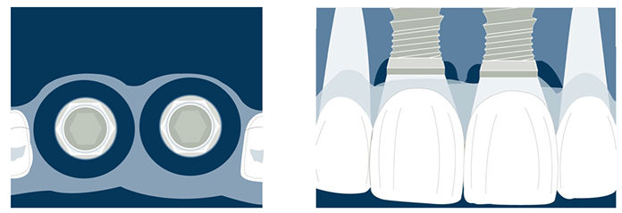 implants in the aesthetic zone and the importance of the distance and the inter proximal bone
