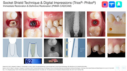 socket shield in implants in the aesthetic zone