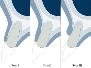 Elian Classification 2007 for socket preservation and also useful in immediate implants in the aesthetic zone.