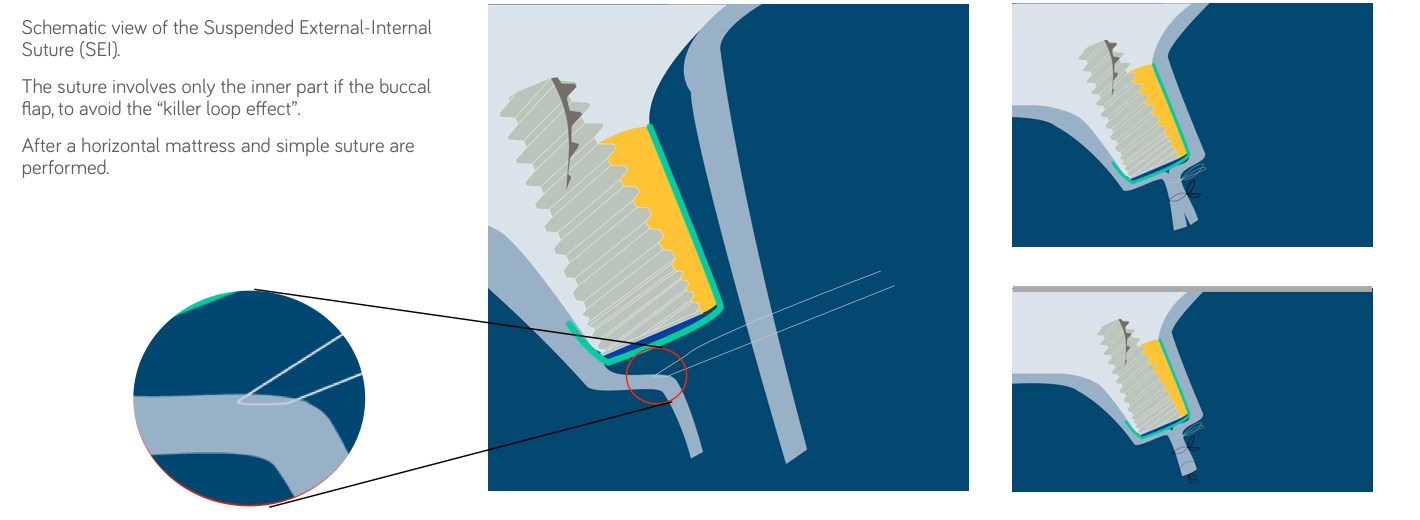 to ensure a wound closure external-internal suture can be very useful