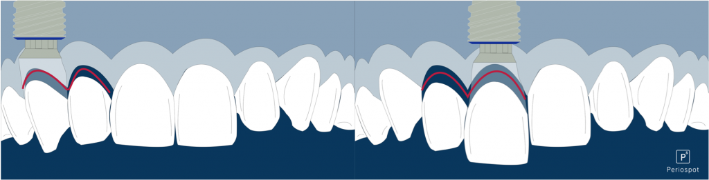 Cantilever restoration aesthetic zone