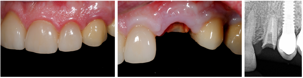 Fractured left canine