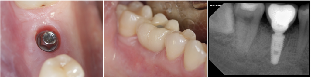 Healing after 2 months, the definitive restoration was delivered.