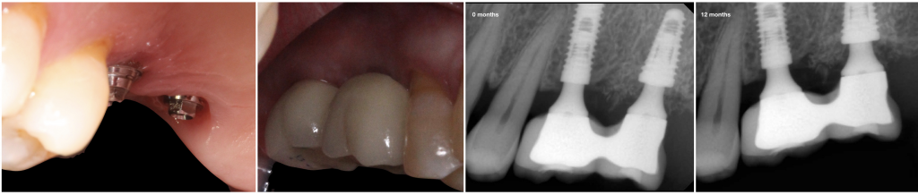 Follow up after 12 months. Peri-implant soft and hard tissue were well preserved.