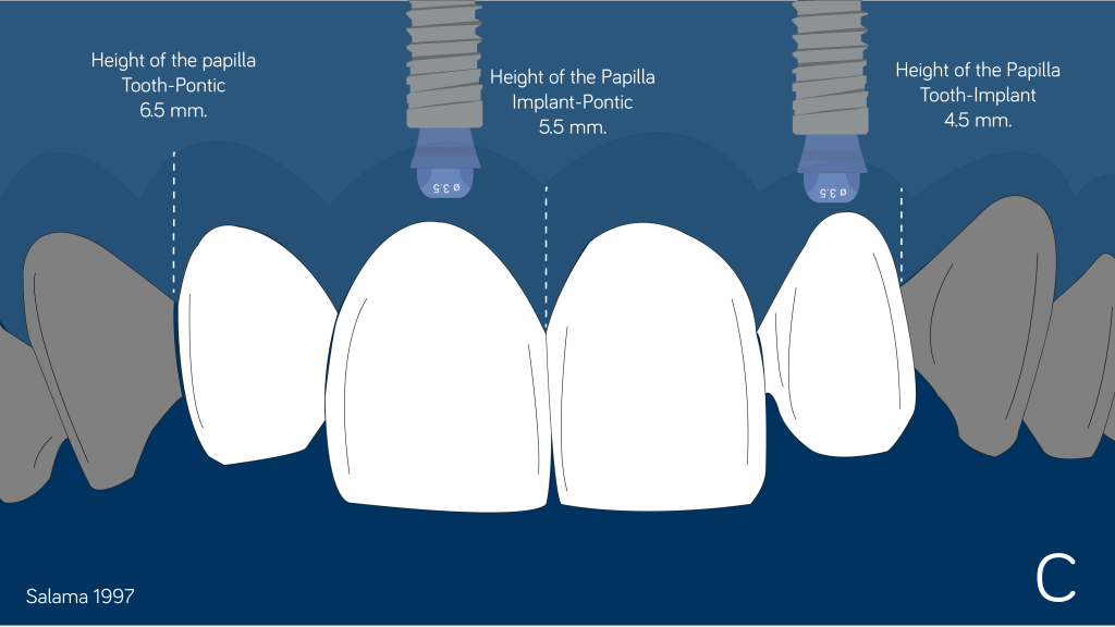 distance to keep between teeth and implant and the expected papilla between implant-poetic, implant-tooth