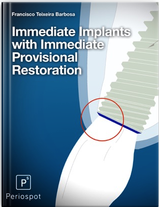 immediate implants ebook in the aesthetic zone