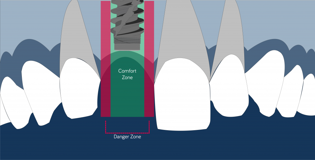 confort zone mesiodistal position implant 1.5 mm