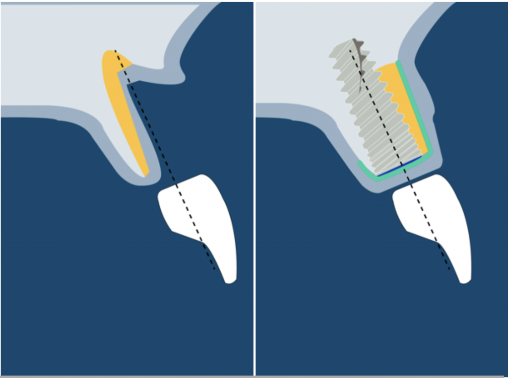 Class III defect in guided bone regeneration