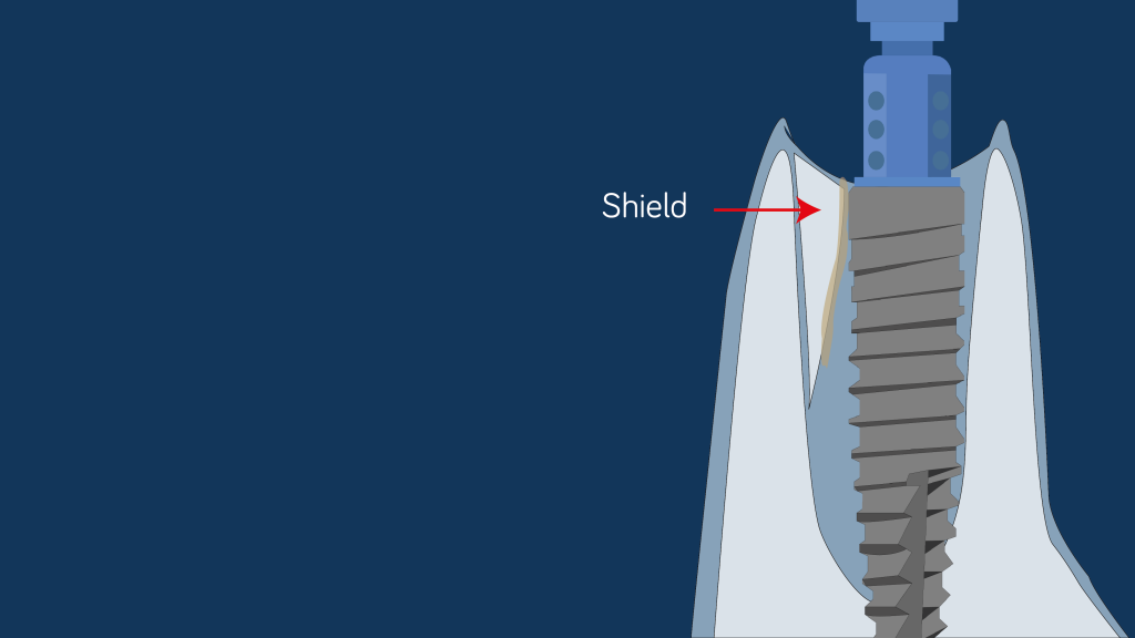 Socket Shield Straumann