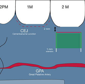 connective tissue graft from the posterior palate