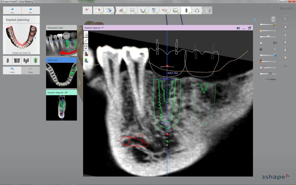3Shape implant studio allows to merge a intramural scanning with a CT scan. We can also evaluate the Hounsfield units where the implants are going to be placed. Important in immediate loading