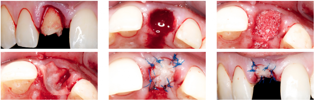 alveolar ridge preservation plays an important role in implant dentistry