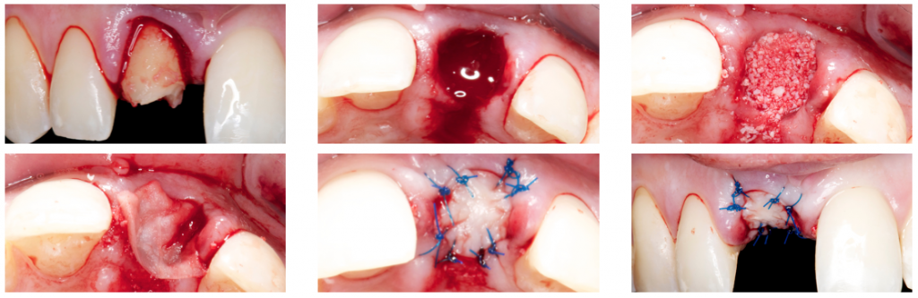 Alveolar ridge preservation using the Ice Cone technique 