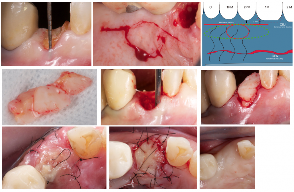 Alveolar ridge preservation using the stimmelmayer technique