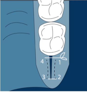 Connective tissue graft techniques from the tuberosity. Sutures.