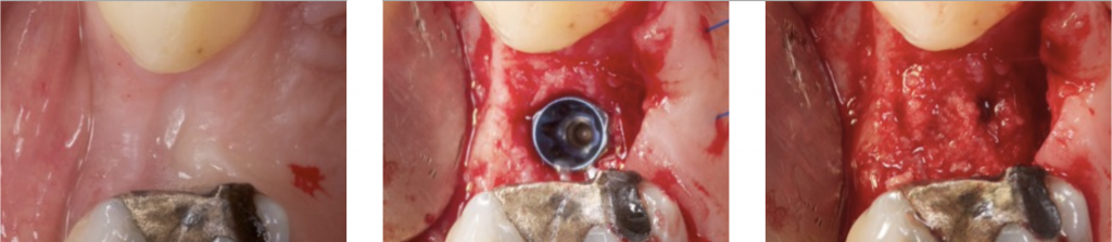 Guided bone regeneration in class 0 defect