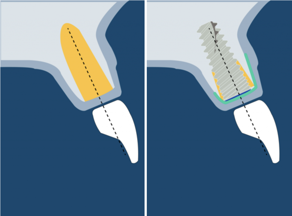 Guided bone regeneration in class 1 defect