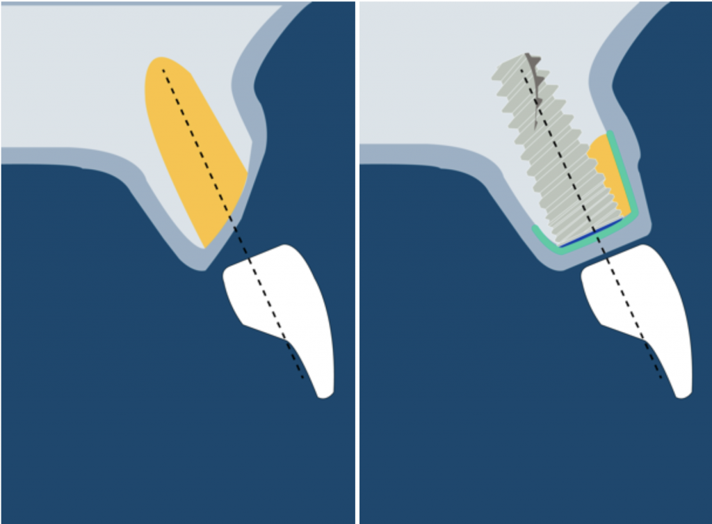 Guided bone regeneration in class 2 defect